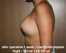 plastic-surgery-breast-augmentation